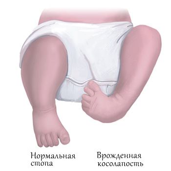 טיפול בכף רגל קלובה ללא ניתוח